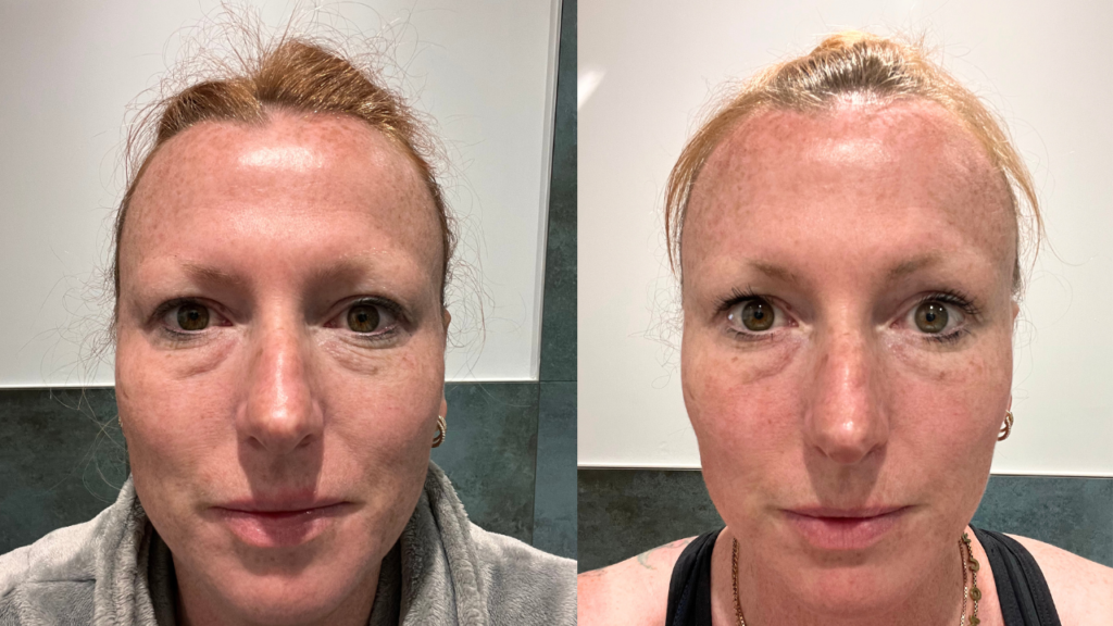 castor oil dark circles before and after